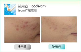 coldelcm秋臣祛痘试用效果